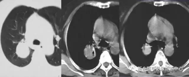 肺部有球形病灶怎么治疗,肺内多发结节诊断早期肺癌怎么办