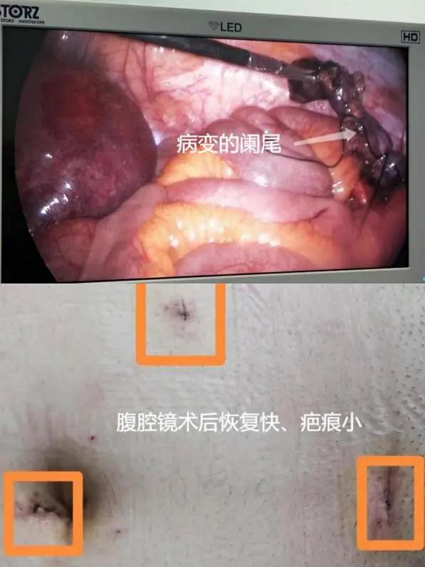 【健康直通车•第十七期】孕妈遇上阑尾炎及时治疗保平安