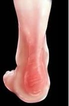 银屑病关节炎炎症怎么消除,银屑病关节炎扶他林乳膏