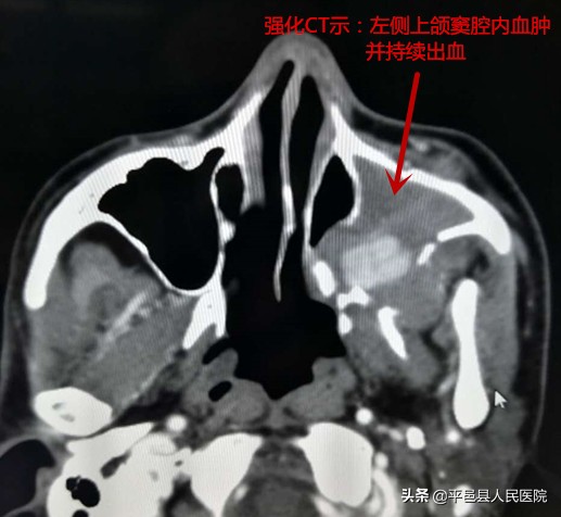 鼻出血止血的方法有血管栓塞法吗,介入治疗鼻出血是怎么操作