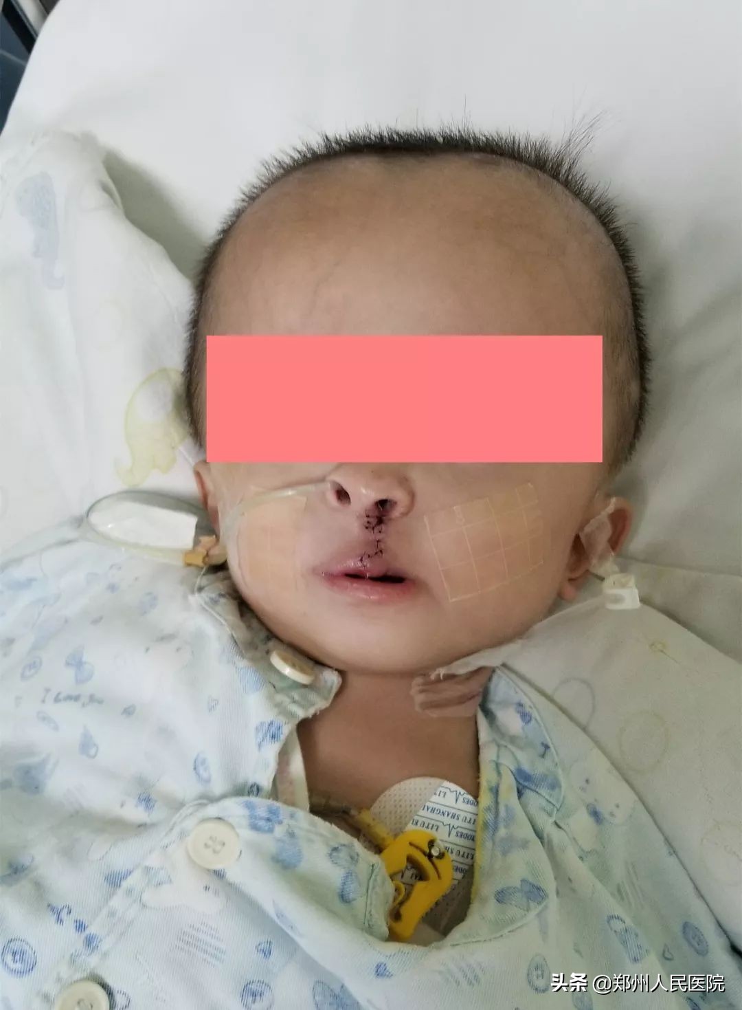 严重唇腭裂修复效果,唇裂修复对比照片