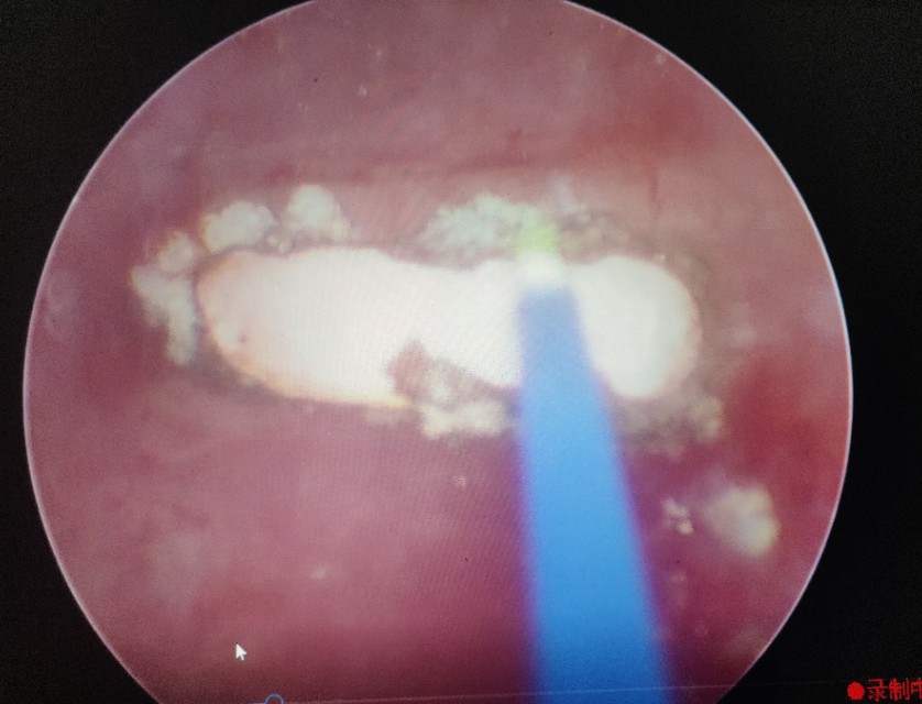 腹腔镜手术取节育环,节育环取出手术