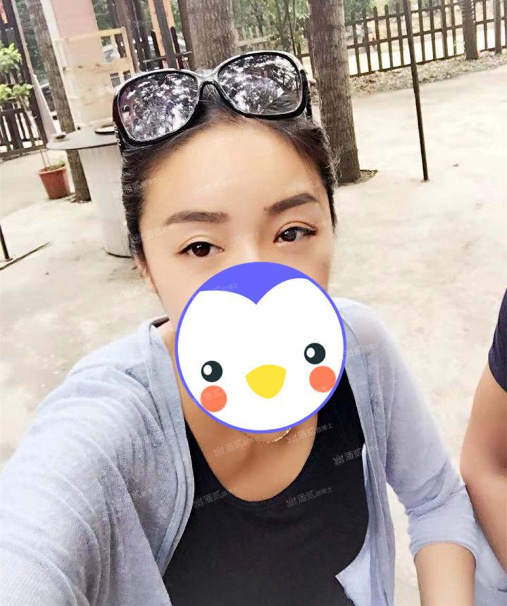 提肌矫正失败的表现眼皮睁不开,做完提肌眼睛前半段下垂