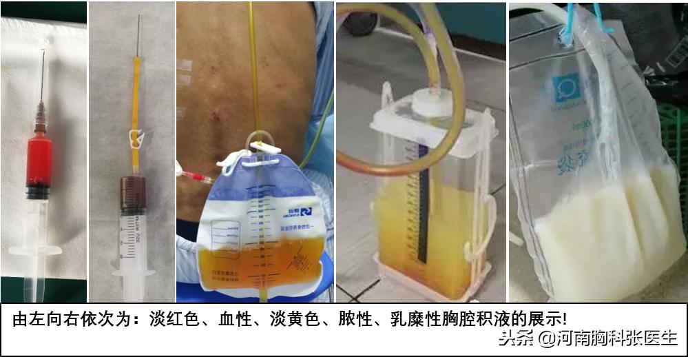 胸腔积液查不出病因怎么办,胸腔积液的病人如何听诊