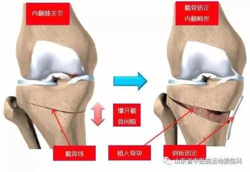 膝关节骨性关节炎到底该怎么治？这篇全说透了