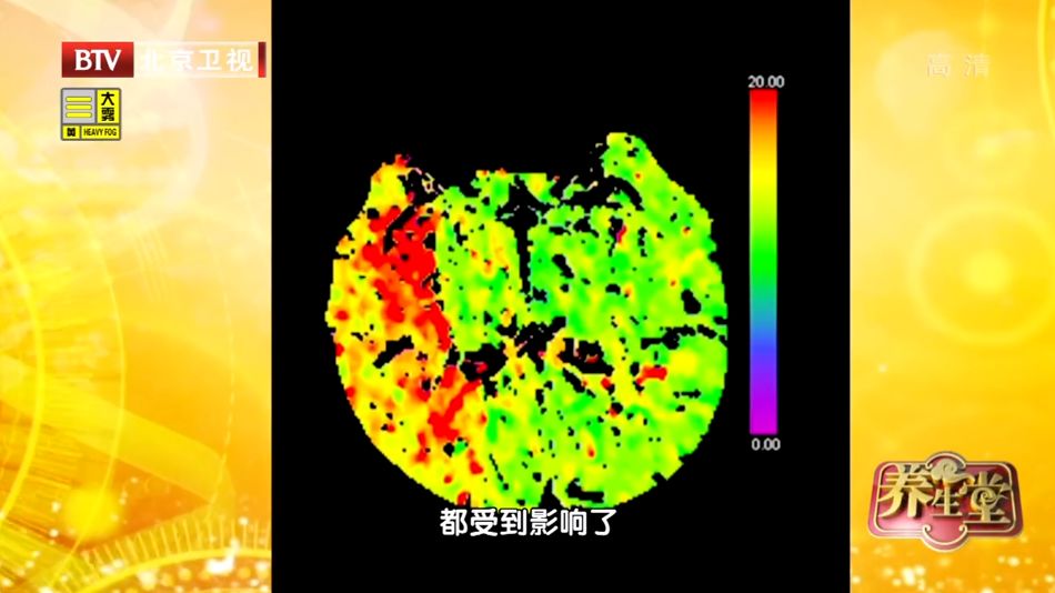 脑血管极细是不是特别危险,脑血管狭窄致命吗