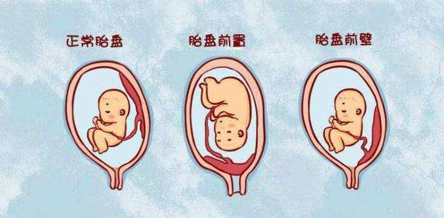 胎盘过低要关注什么吗,胎盘过低是怎么回事