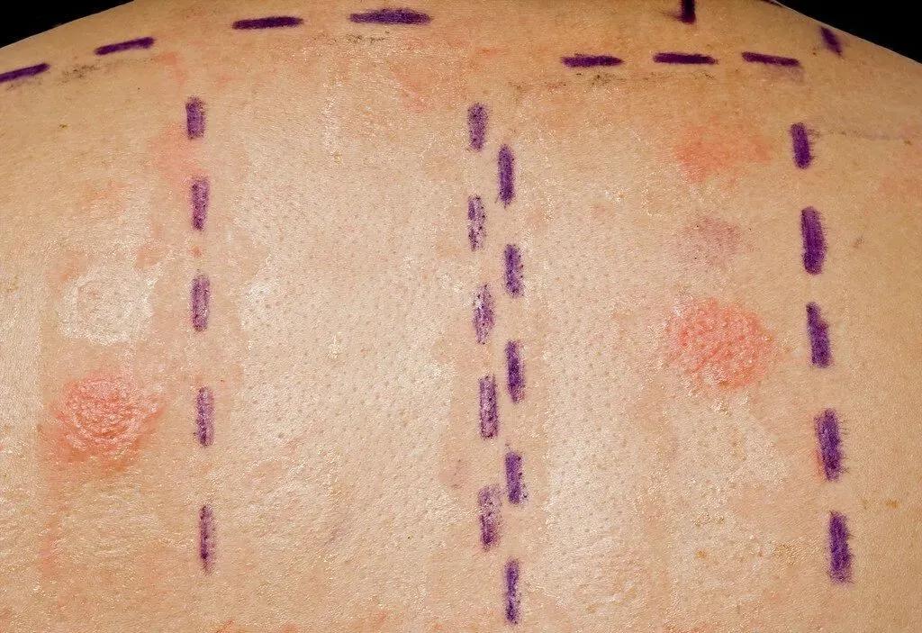 得接触性皮炎的原因有哪些,眼皮接触性皮炎用什么药膏