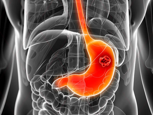 胃癌初期症状三处痒,胃癌的早期症状有三处疼痛