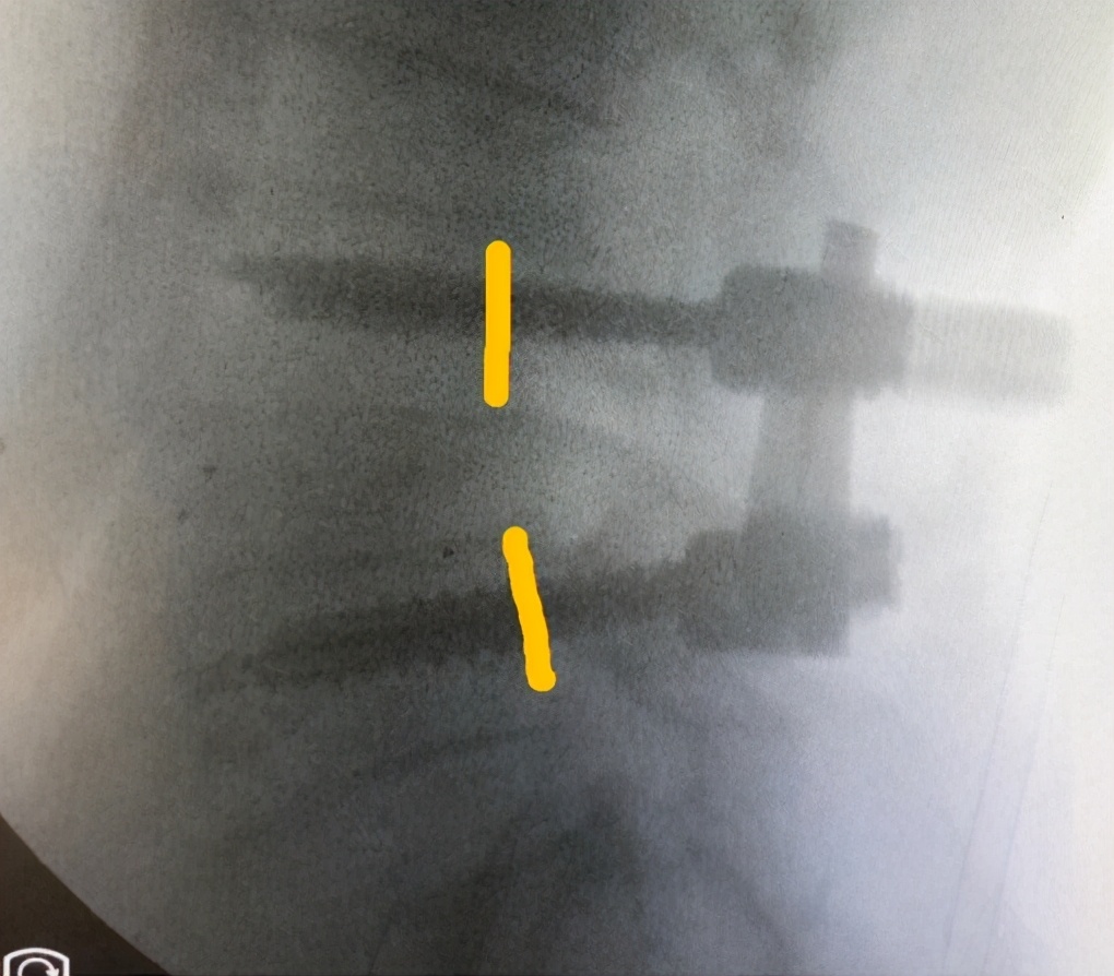 腰椎退行性变诊断书怎么写,腰椎退行性滑脱最好的治疗方法