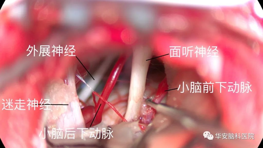 面神经显微血管减压手术,面肌痉挛显微减压术
