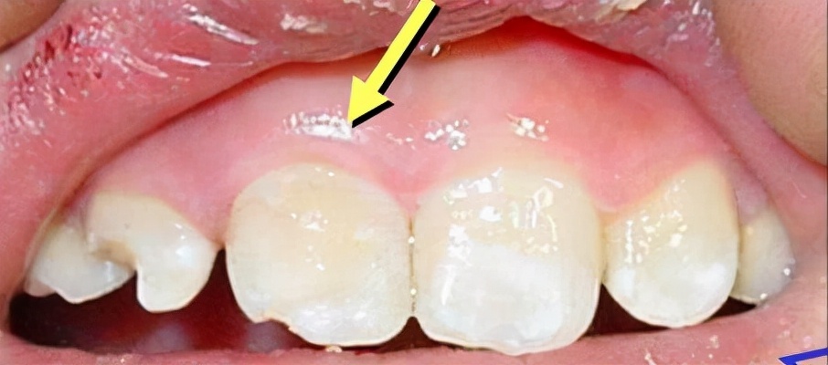 孩子摔一跤嘴唇里面裂了,孩子在学校摔断门牙怎么办