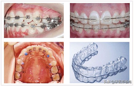 半隐形矫正价格表,隐形矫正哪里做比较好