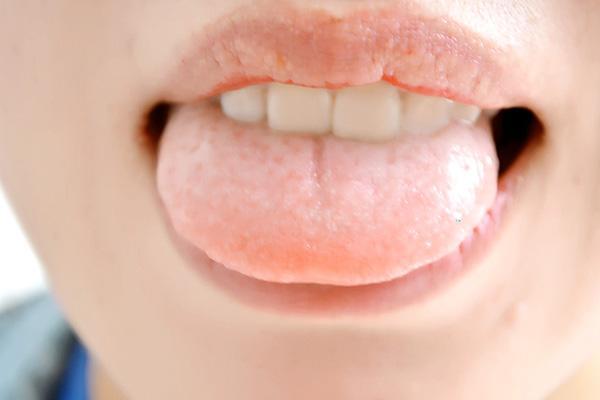 舌苔是健康“放大镜”，正常舌苔什么样？不同舌苔说明哪些问题？