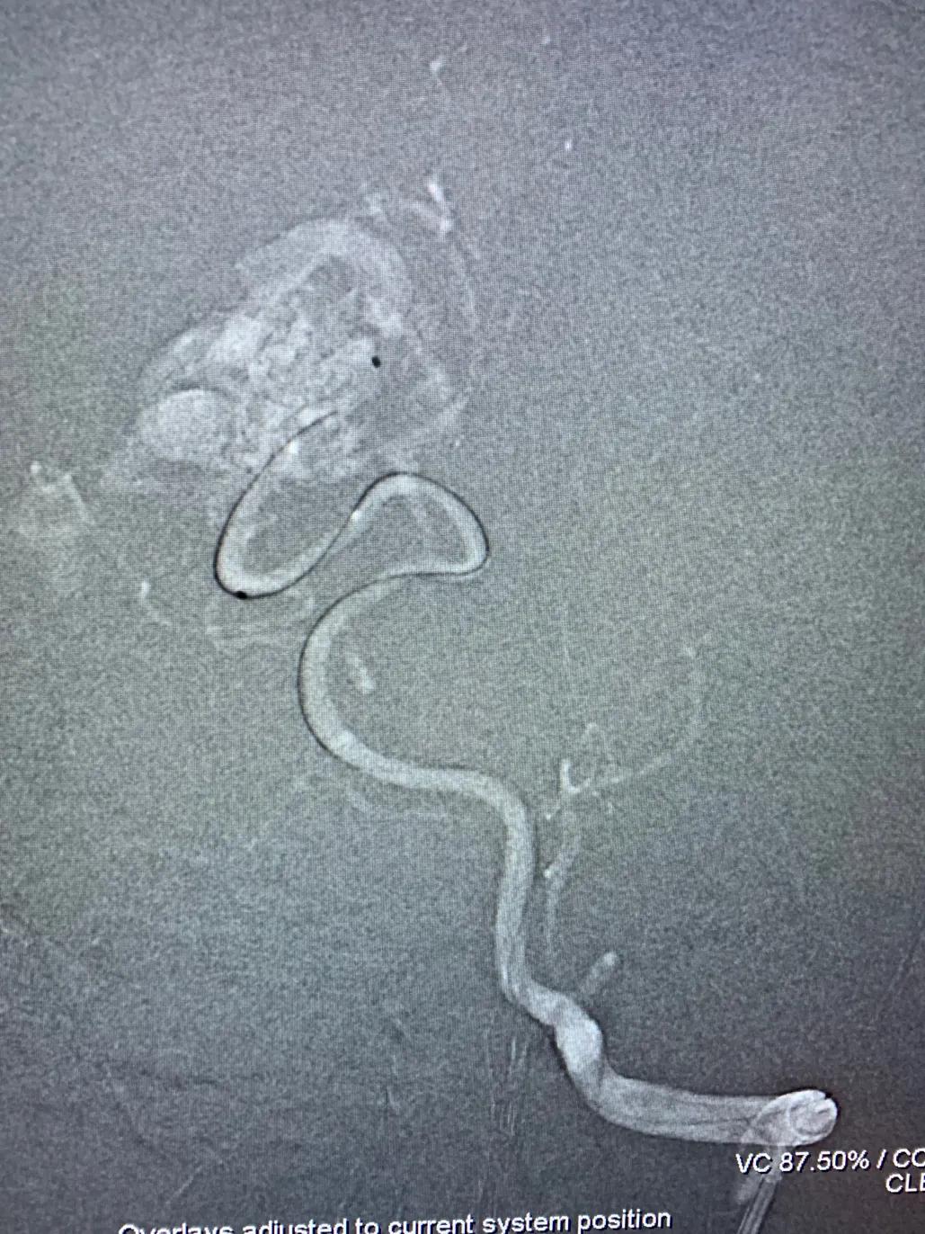 脑动静脉畸形介入栓塞手术的风险,介入栓塞技术在脑avm治疗中的作用