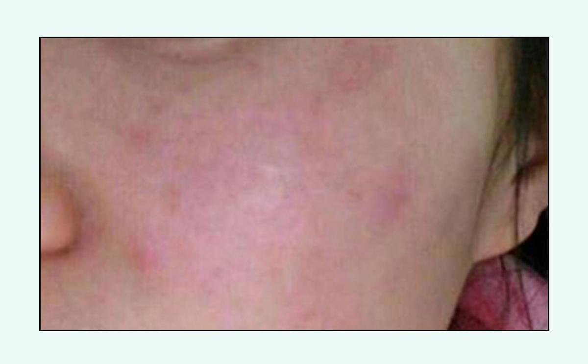 脸上的红疙瘩疼是什么原因,脸上的各种疙瘩