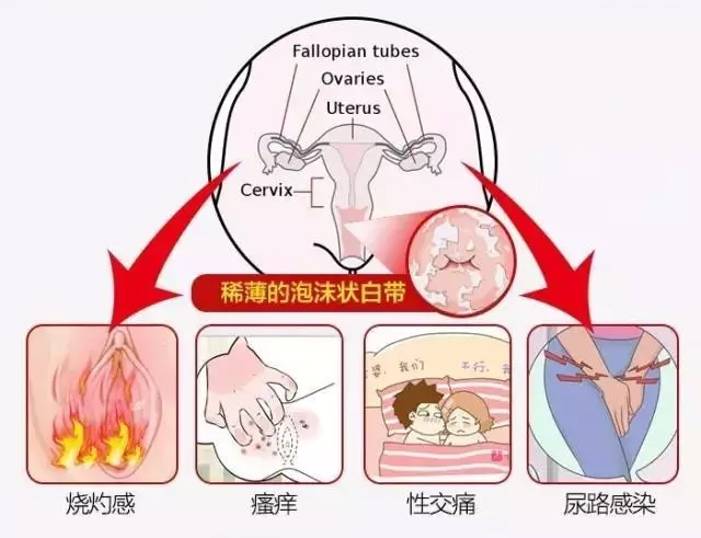 滴虫性阴道炎是身体里有虫子吗？