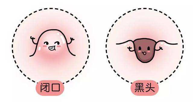 痘博士6个方法改善肌肤痘痘问题,如何预防闭口长出并解决闭口问题