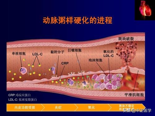 冠心病能治好吗,冠心病能治好吗最真实的经验分享