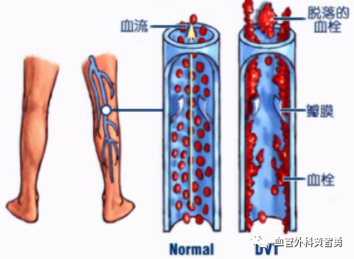 孕期下肢静脉血栓怎么治疗,卧床保胎预防血栓的腿部动作