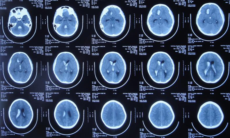 儿童脑出血昏迷三天后恢复正常了,脑出血后脑积水多久会出现症状