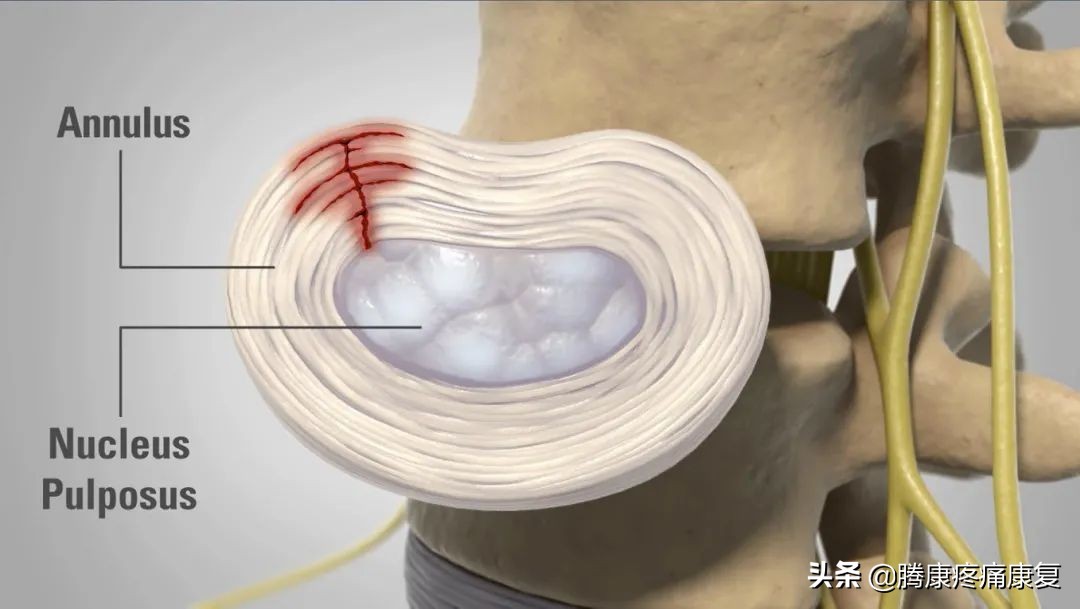 腰椎间盘退行性改变怎么治疗呢,腰椎间盘退行性改变是什么意思