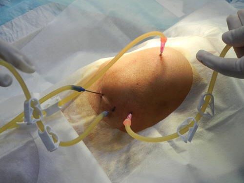 老百姓能看懂的膝关节炎治疗指南