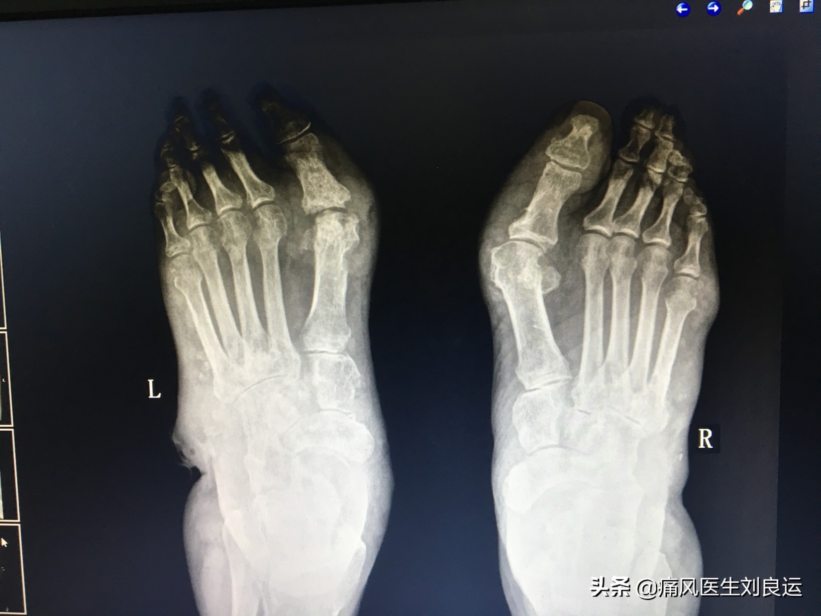 尿酸正常了可以手术取痛风石吗,痛风石可以做手术取掉吗