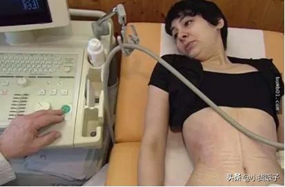 内脏下垂、子宫脱落、漏尿…今天和你一起说一说束腰的危害