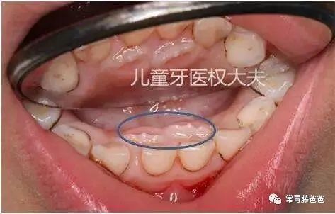 5岁双排牙最佳解决方法,宝宝换牙期长出双排牙需要拔掉吗
