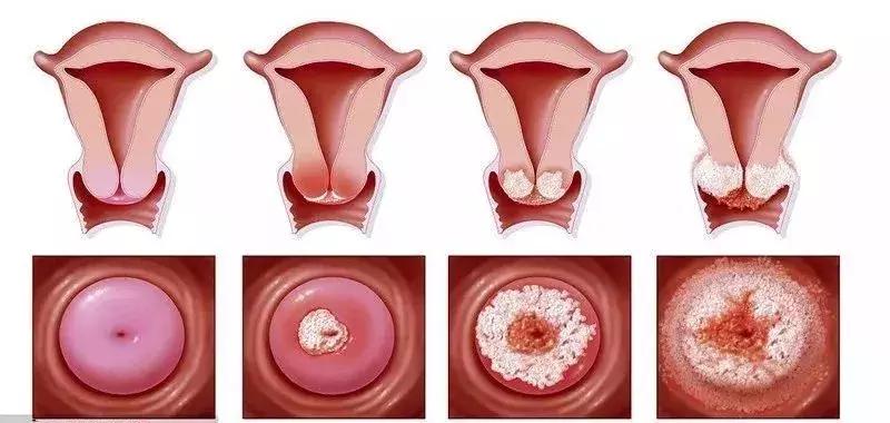湿热引起的妇科炎症怎么办,妇科炎症有哪些症状治疗方法