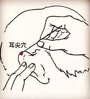 青春痘反复发作惹人烦，不妨试试针灸治疗