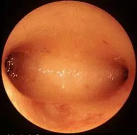 多年不孕容易长子宫肌瘤,多年不孕怎么找原因