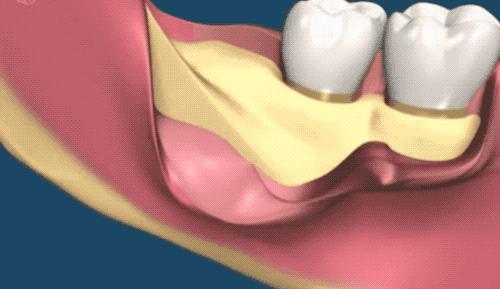 拔了一颗智齿花了1300元贵吗,拔个智齿花了800