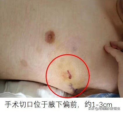 手汗症需要治疗吗,手出很多汗是什么病