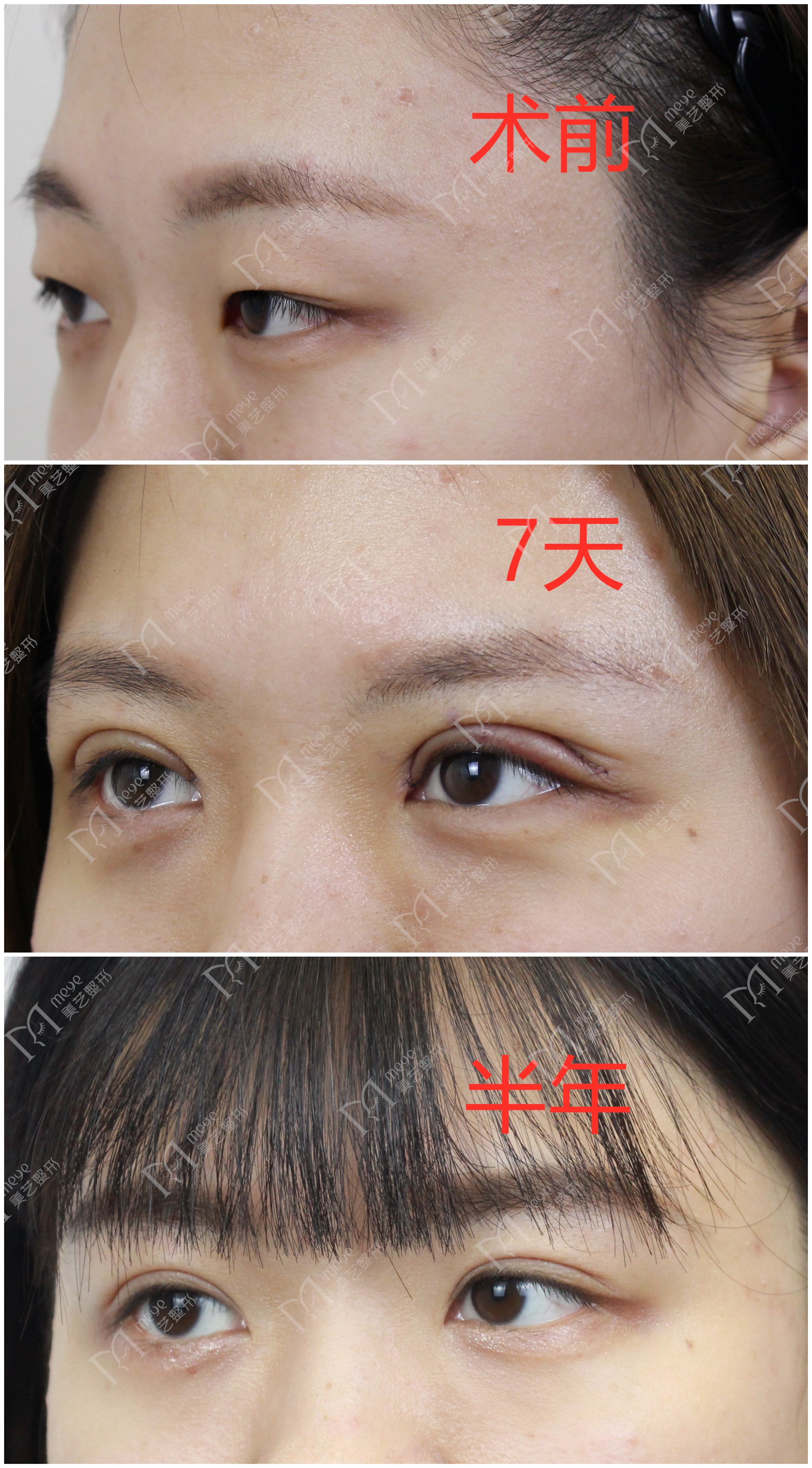 双眼皮术后出现肉条怎么办,双眼皮肉条感修复手术痛吗