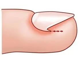指甲老往肉里长化脓,指甲为什么一直往肉里长