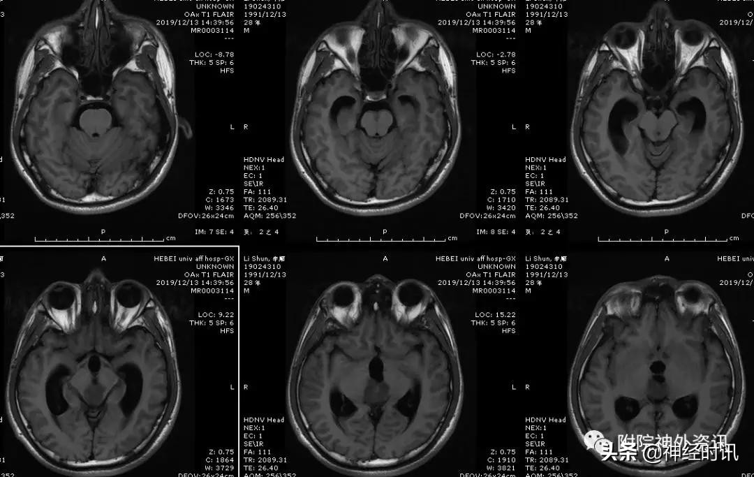 松果体占位怎样治疗,松果体区占位看什么科室
