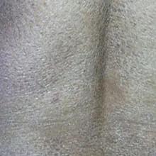 鱼鳞病分类及症状,鱼鳞病怎么区分类型