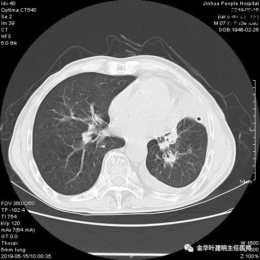 肺手术后乳糜胸是医疗事故吗,肺部切除后乳糜胸治好了