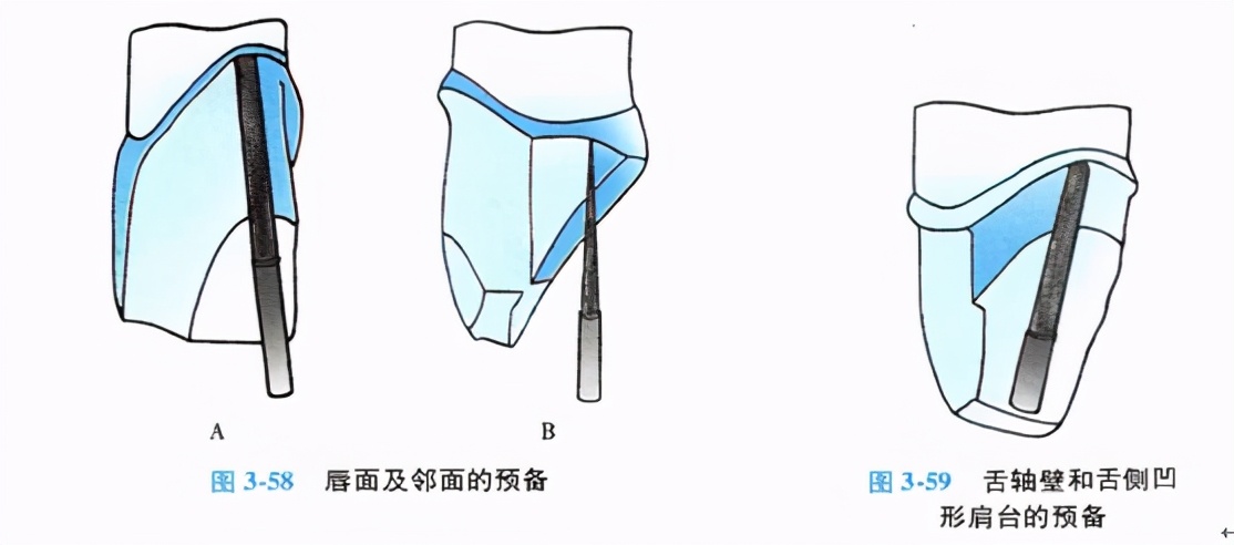 口腔金属冠与全瓷冠的区别,牙科医生讲义