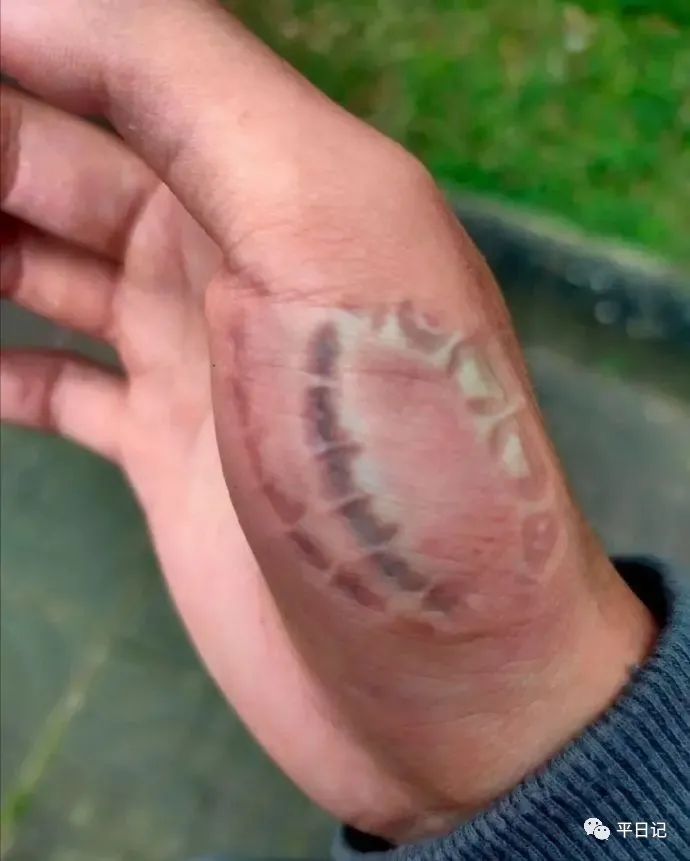 被老婆咬了后怎么处理,被老婆咬了要报警吗