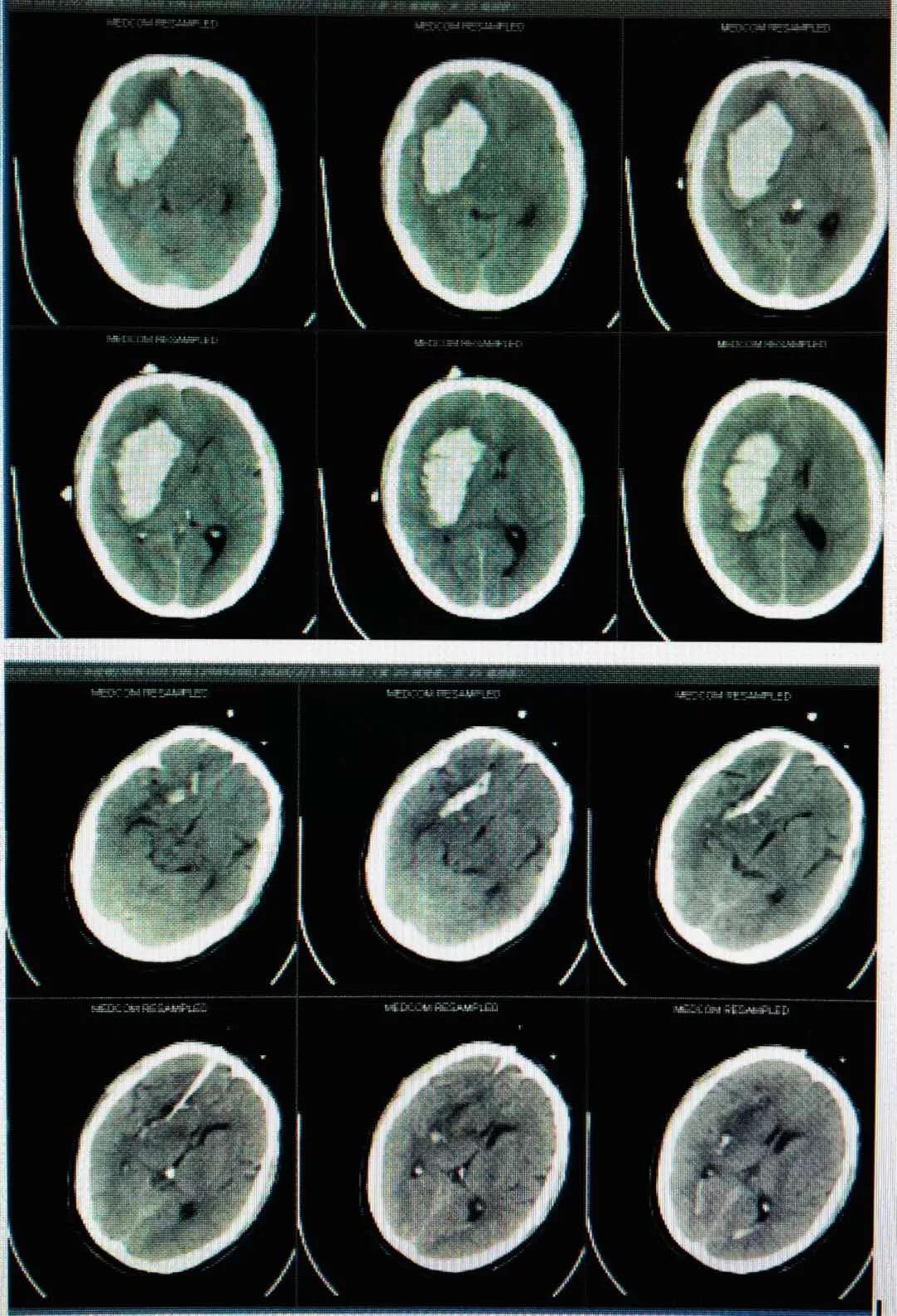 泉州：突破！永春县总医院成功开展新技术
