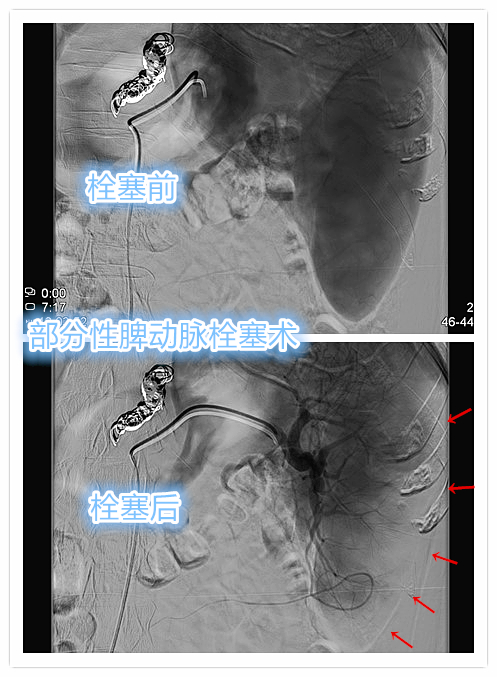 脾功能亢进导致血小板减少怎么办？