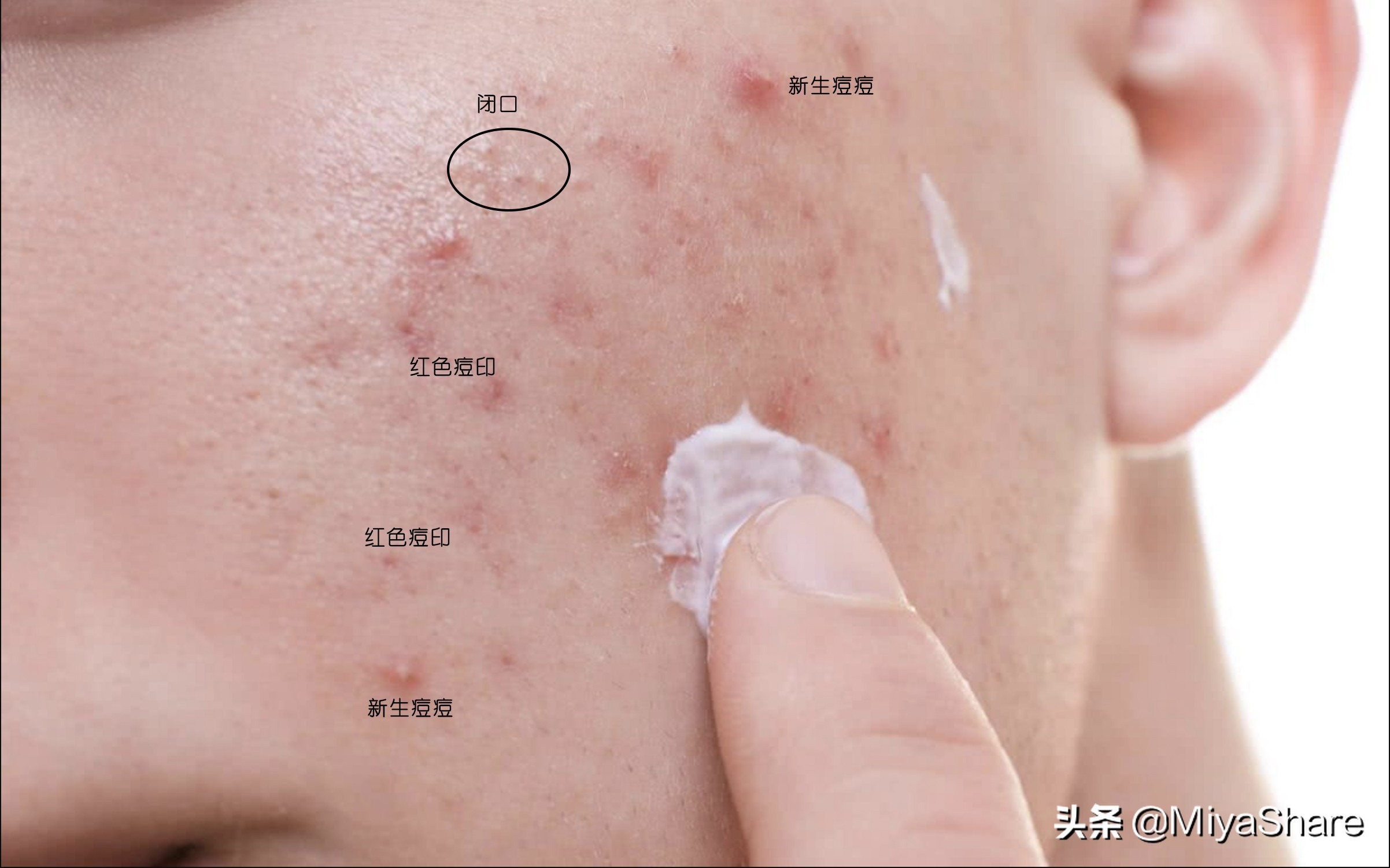 长痘后如何正确处理,长痘之后如何去红