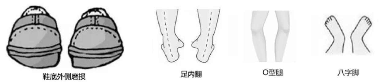 走路费鞋后跟,如何通过鞋底判断走路姿势