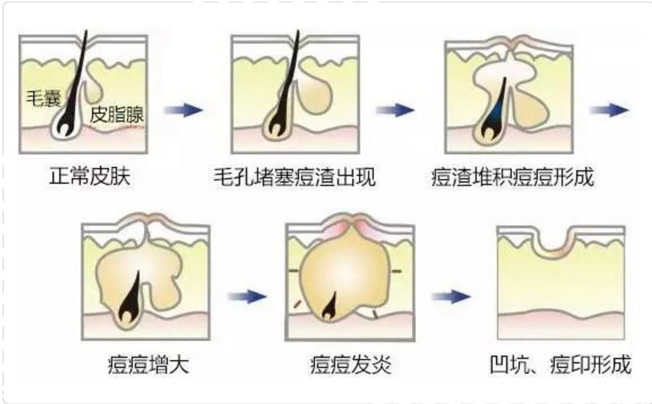 祛痘印小妙招学生党怎么祛痘印,痘印肌肤很闹心教你祛痘印小妙招