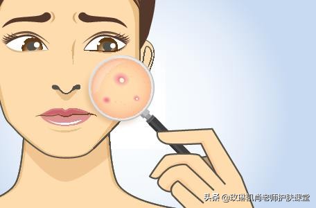 额头下巴后背长痘痘是怎么回事,额头下巴下颌线长痘是什么原因