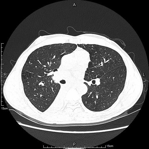 肺癌微创介入治疗好用吗,局部晚期肺癌可以做根治性放疗吗