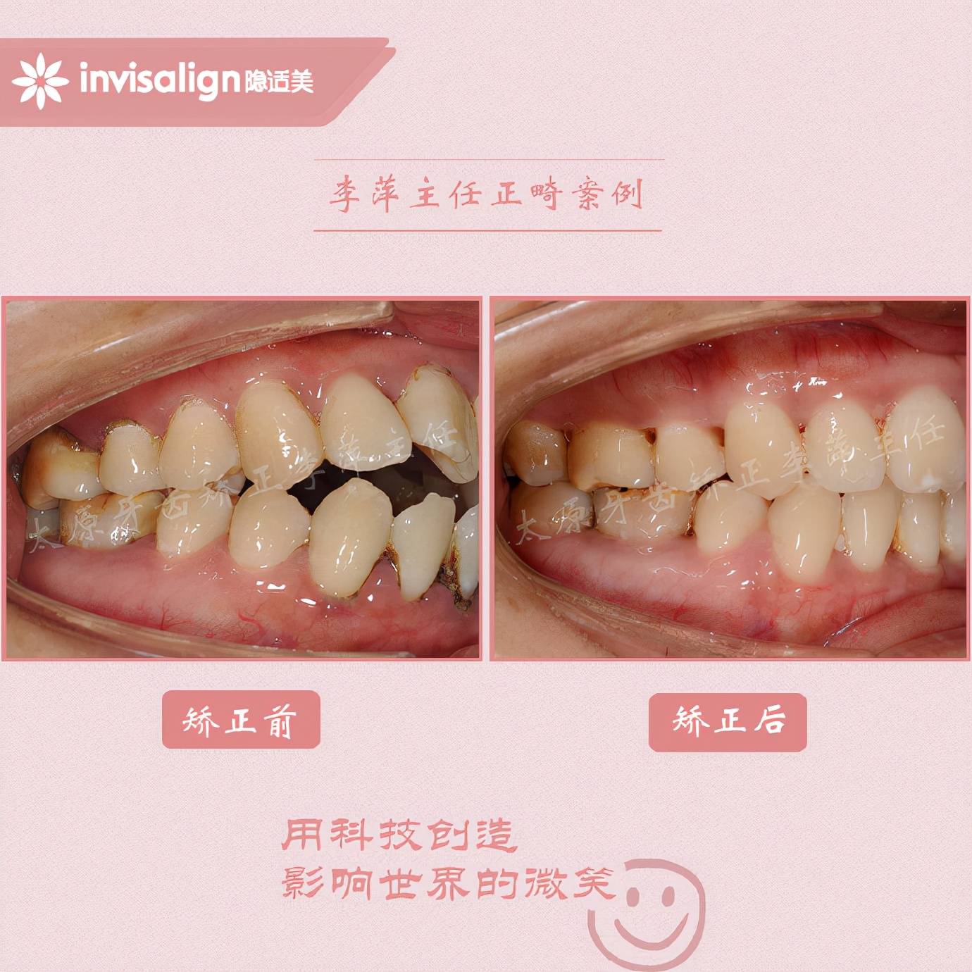 成都牙齿有缝隙怎么矫正,牙齿拥挤矫正前两天不痛正常吗